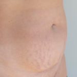 hysterectomy scar